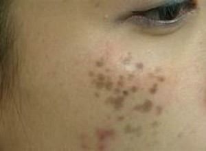 Nám chân sâu và những điều bạn nên biết 